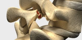 Spondylolisthésis : causes, symptômes et traitement Spondylolisthésis