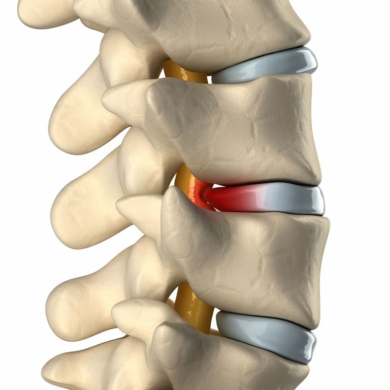 Depiction of disc herniation causing central canal stenosis. cliparea