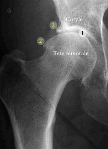 Radiographie d'une hanche arthrosique. 1. Pincement articulaire 2. Ostéophytes 