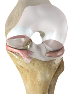 NUsurface® Meniscus Implant