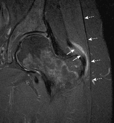 IRM, coupe coronale en T2 avec suppression de graisse d'un patient avec douleur externe de hanche et bursite trochantérienne, avec du liquide en hypersignal qui siège entre le tractus iliotibial (flèches blanches en pointillés) et le tendon du petit glutéal (flèches blanches).