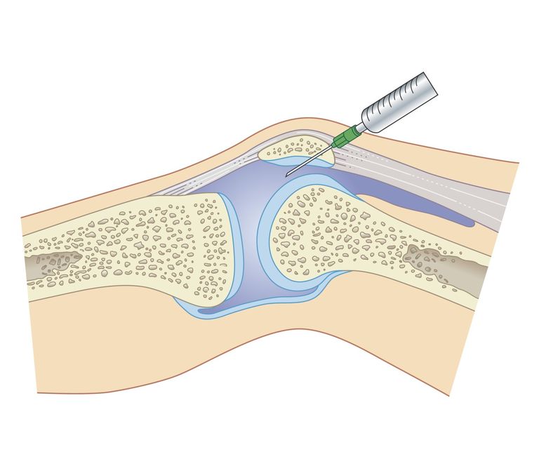 Infiltration intra-articulaire du genou. 