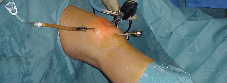 Arthroscopie du genou