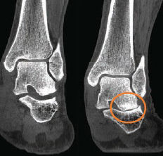 L'image à gauche d'une cheville en décharge ne révèle pas l'arthrose. L'image à droite en charge révèle le pincement articulaire. 