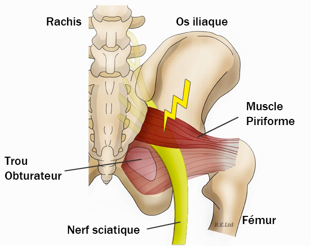 Siège de la compression du nerf sciatique par le muscle pririforme. 