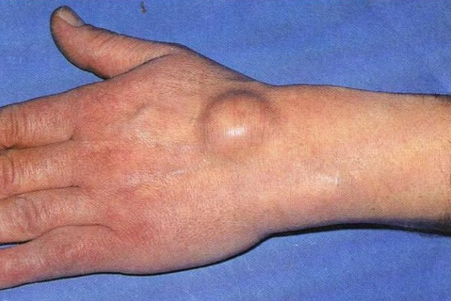Kyste synovial du poignet : les méthodes du traitement