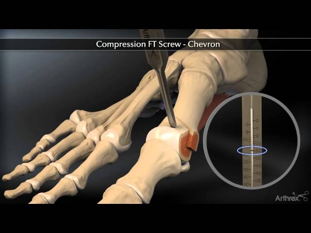 ost-otomie-en-chevron-pour-traiter-l-hallux-valgus