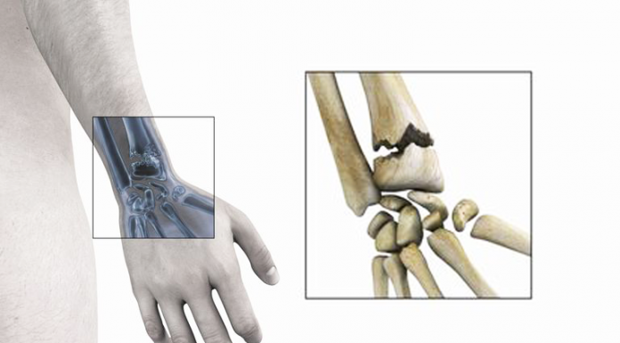 fractures du poignet