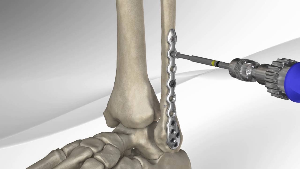 Comment traiter les fractures : techniques, moyens, et évolution