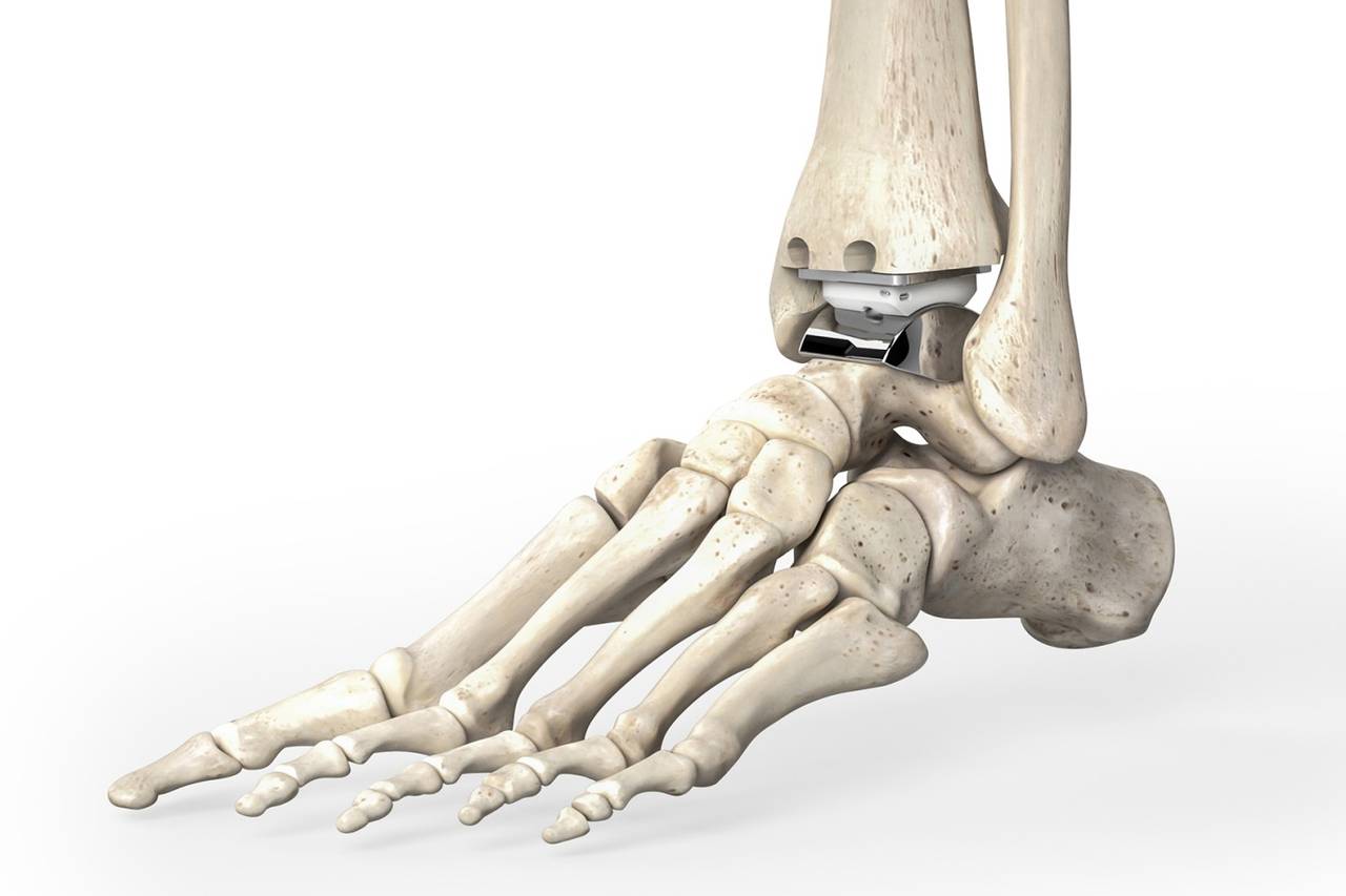 Операция по замене сустава на ноге. Эндопротезирование голеностопного сустава. Эндопротезирование таранной кости голеностопного сустава. Эндопротез голеностопного сустава Wright.
