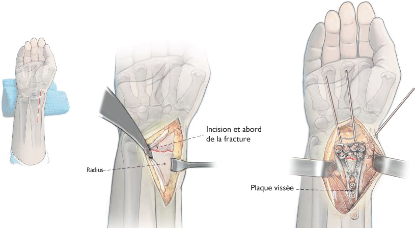 Fracture du poignet Pouteau-Colles - Quels traitements ?