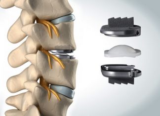 prothèse discale