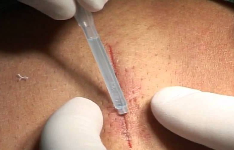 Suturer une plaie : méthodes et délai de retrait des points de suture