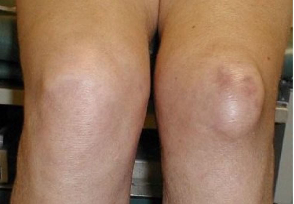 Aspect de l'hygroma du genou